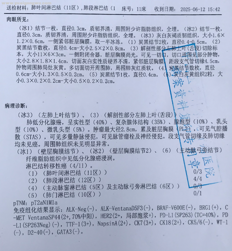 老公刚刚54岁，确诊肺癌，手术中发现转移，病理晚期
